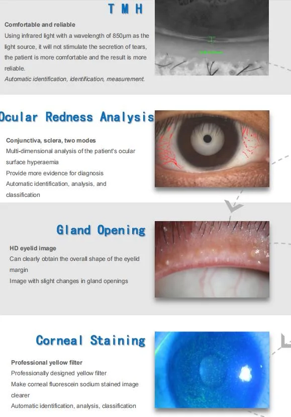 Ocular Surface Analyzer for Dry Eye Examination&Analysis Price for Sale